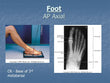 Foot  AP X-RAY