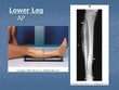 Lower Leg  AP X-RAY
