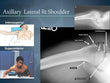 Shoulder Lateral X-RAY