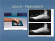 Foot Lateral X-RAY
