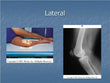 Knee Lateral X-RAY